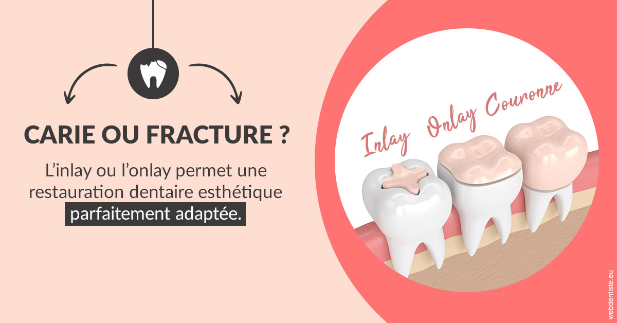 https://dr-samuel-lefevre.chirurgiens-dentistes.fr/T2 2023 - Carie ou fracture 2