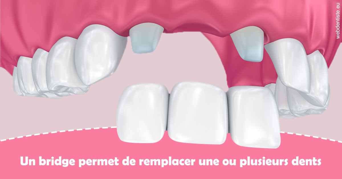 https://dr-samuel-lefevre.chirurgiens-dentistes.fr/Bridge remplacer dents 2