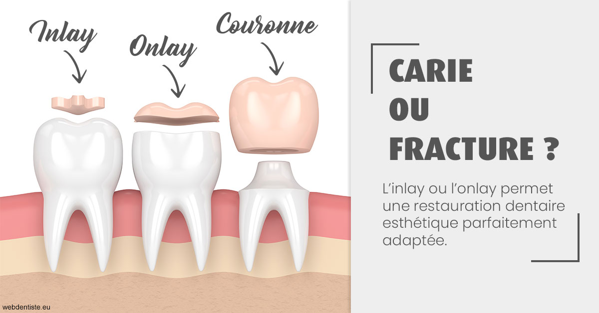 https://dr-samuel-lefevre.chirurgiens-dentistes.fr/T2 2023 - Carie ou fracture 1
