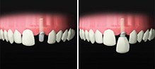 implant_mise_charge_immediate_dents_anterieures